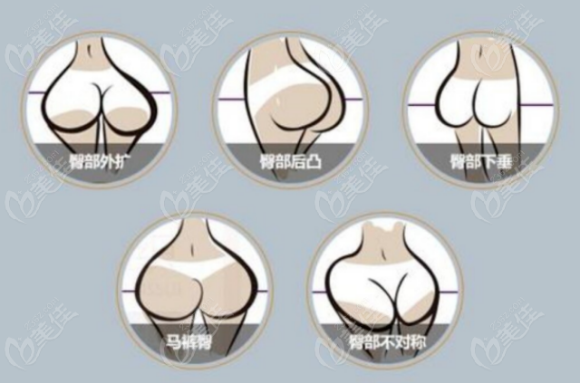 Which Hospitals in South Korea offer Brazilian Butt Lift? Here's the Top 10 Ranking of Butt Augmentation Hospitals in South Korea