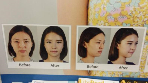 Before and after plastic surgery