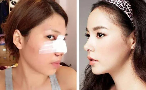 Korean nose job recovery time