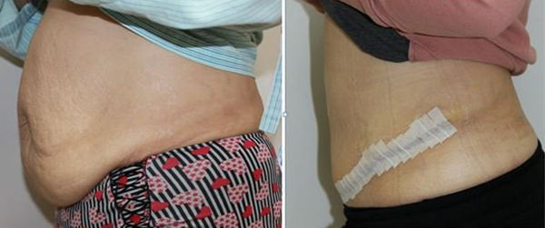 Tummy Tuck