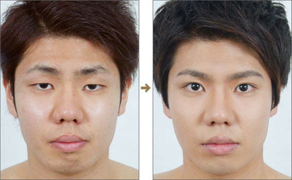 double eyelid surgery