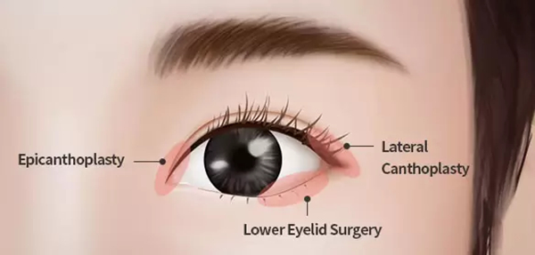 What is Epicanthoplasty