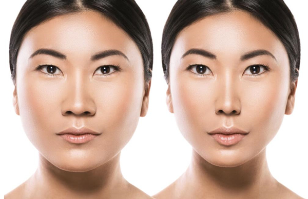 How much is rhinoplasty at ID Hospital