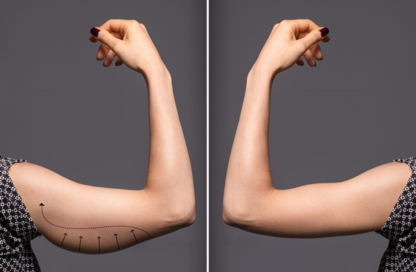 Arm liposuction before&after