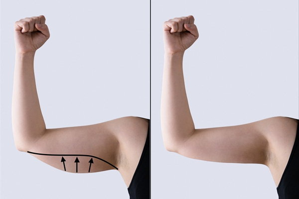 What is Korean arm liposuction