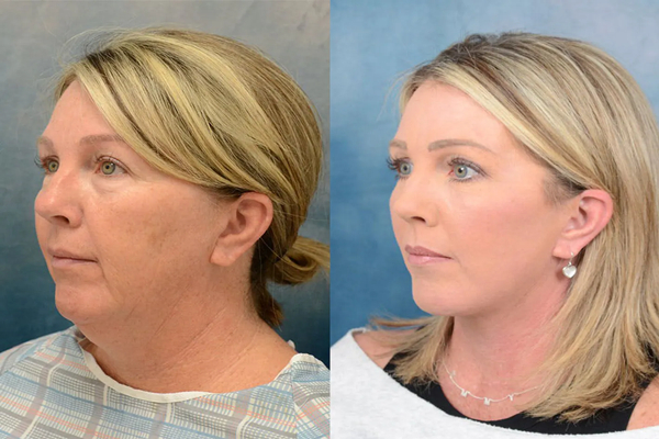 Facelift at Age 60 and beyound