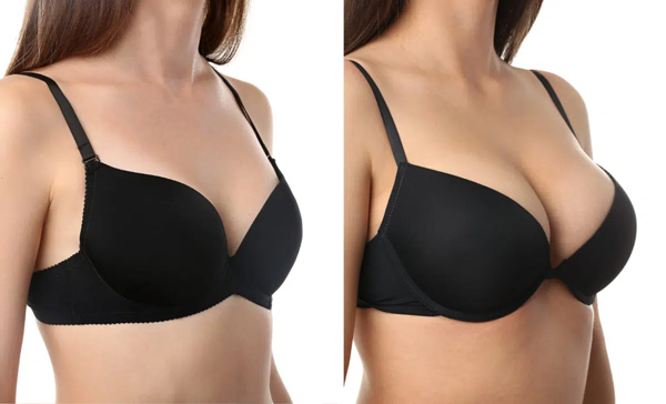 Breast augmentation cost