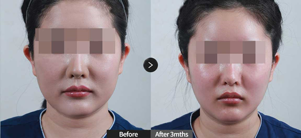 Face Liposuction for females