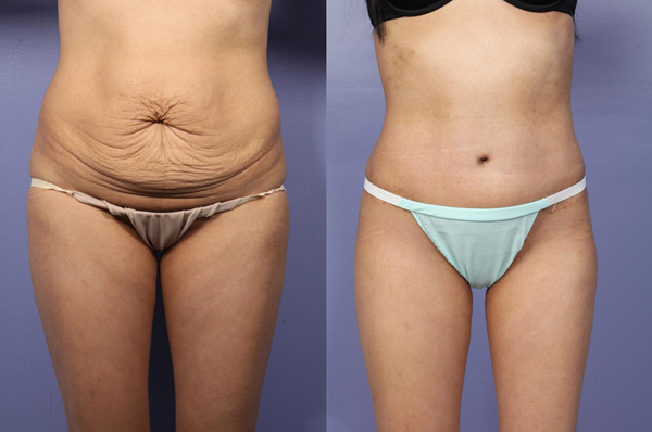 Tummy Tuck Before and After