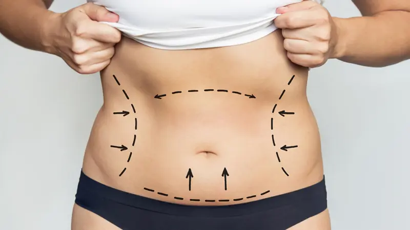 Tummy Tuck Cost