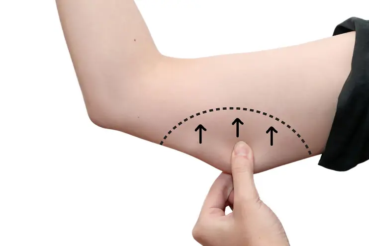 arm liposuction