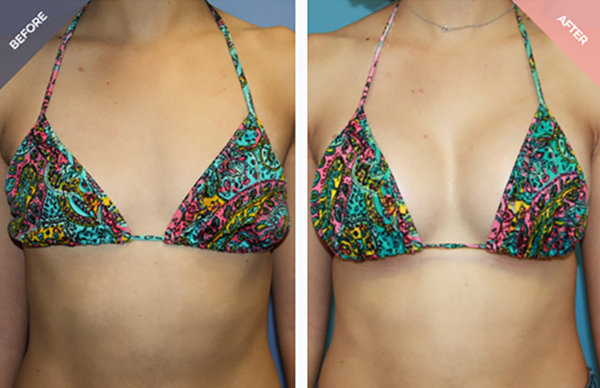 breast augmentation before&after