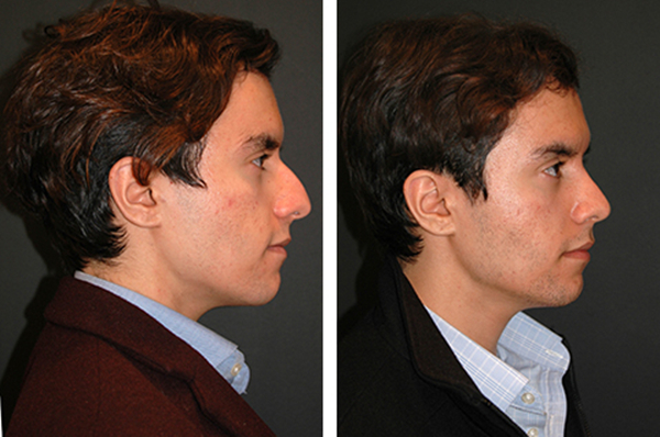 Male Rhinoplasty Cost