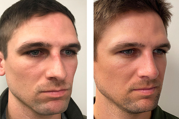 rhinoplasty before and after