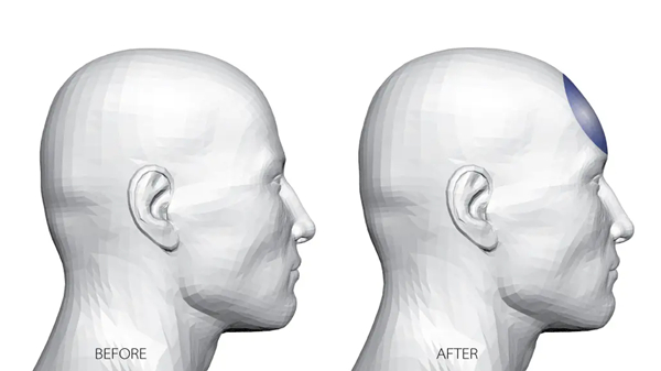 Skull Reshaping Surgery