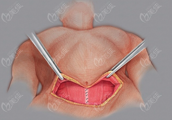 Which Hospitals in South Korea Offer Abdominoplasty?