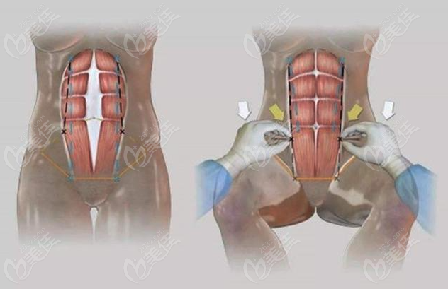 Abdominoplasty