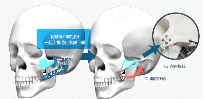 OPERA Plastic Surgery's 3D rotation procedure