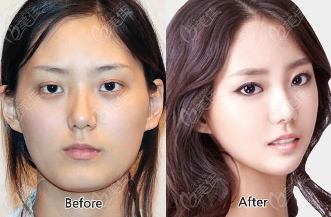 Faceline Plastic Surgery Facial Contouring Example