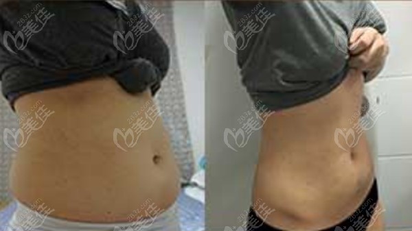 liposuction