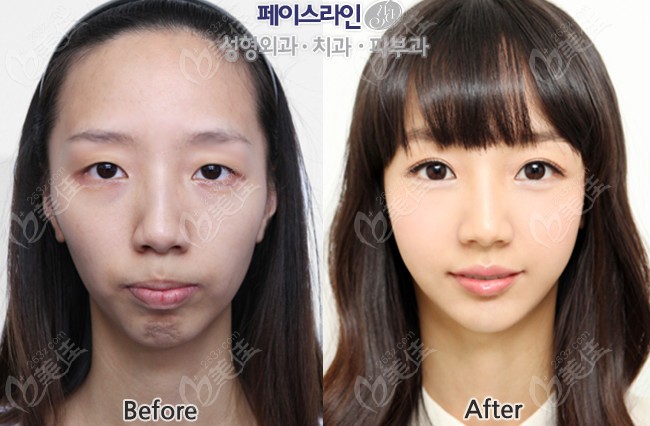 Example of Faceline Plastic Surgery's Double Jaw Surgery