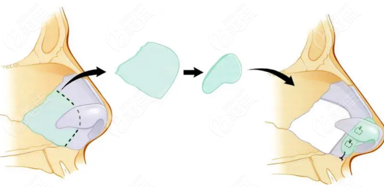 Which is Better for Nose Reconstruction, Japan or South Korea?