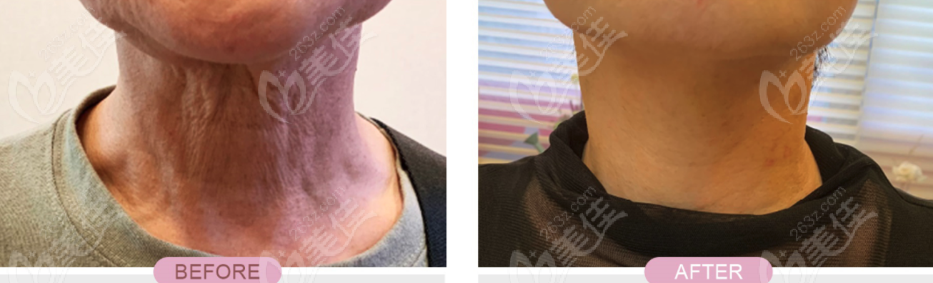 neck wrinkle before and after