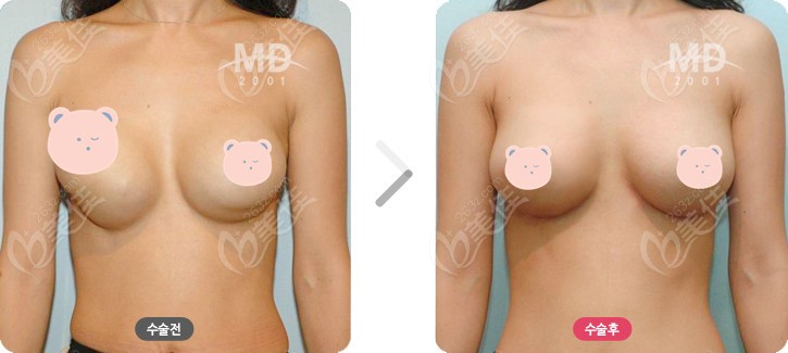 breast augmentation