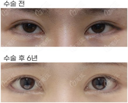 Cheng Zhenmo-Eye Repair surgery