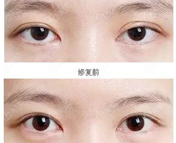 Cao Renchang-Eye Repair surgery