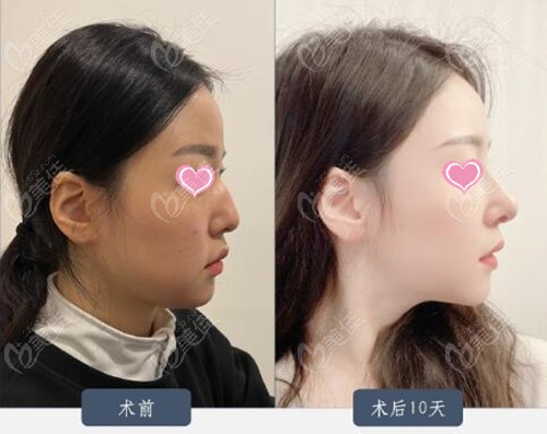 Description of a successful nose job