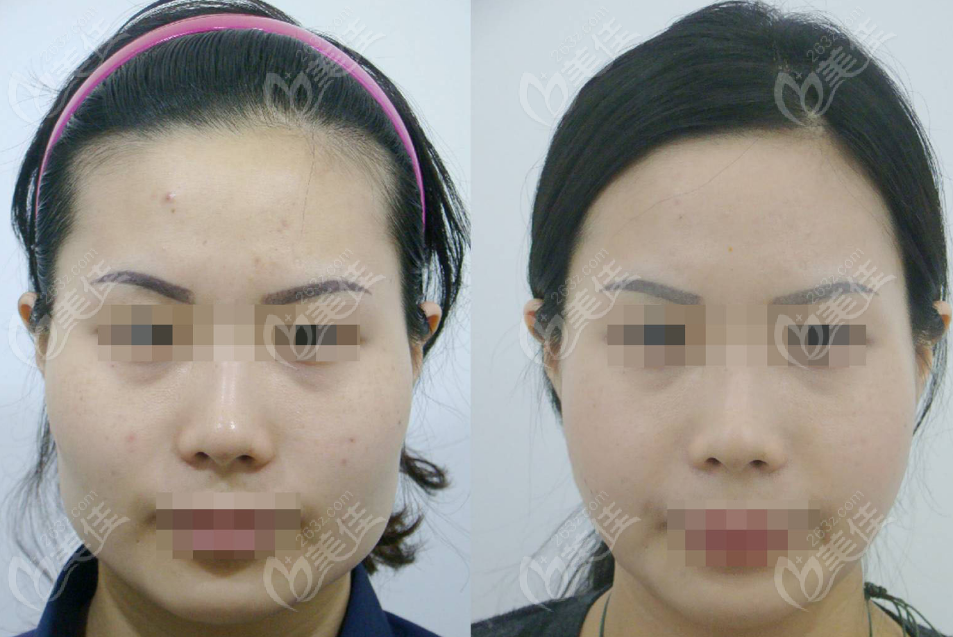 Facial Contouring