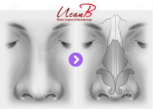 rhinoplasty