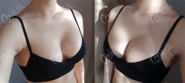 Endoscopic Breast Augmentation