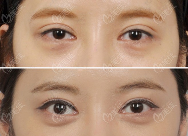 Eyelid Repair Before and After Comparison