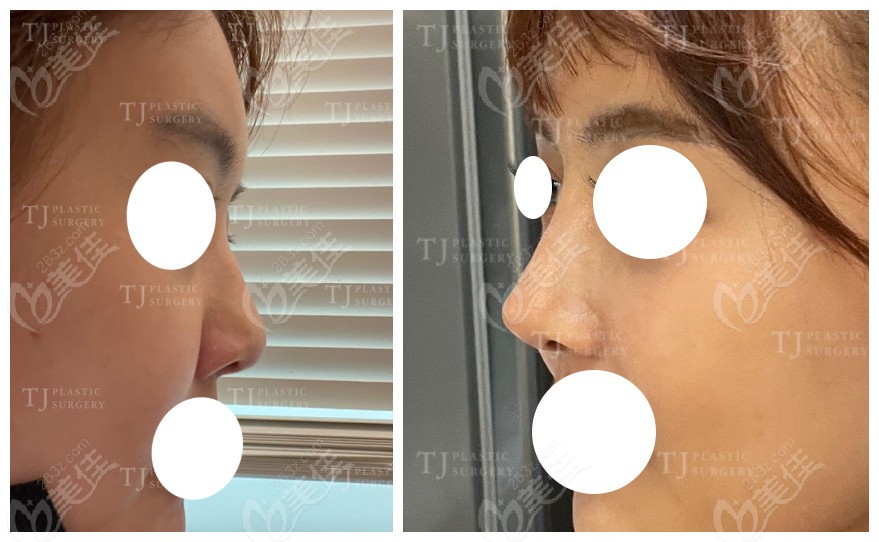 comparison of TJ Plastic Surgery's silicone nose before and after