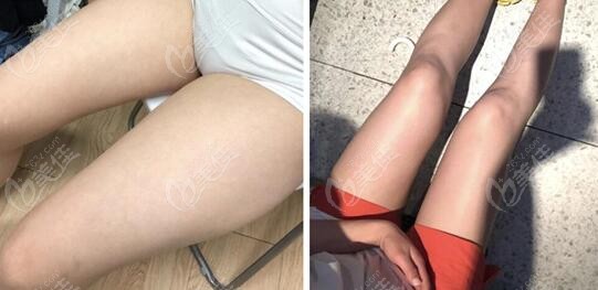 before and after photos of thigh liposuction