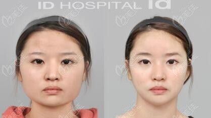 cheekbone reduction double jaw surgery