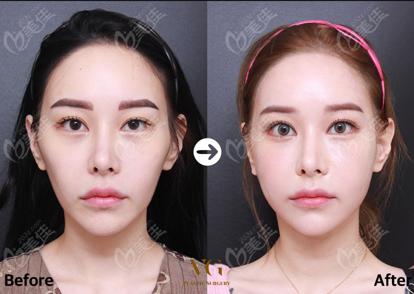 reducing cheekbones and jaw angle removal 