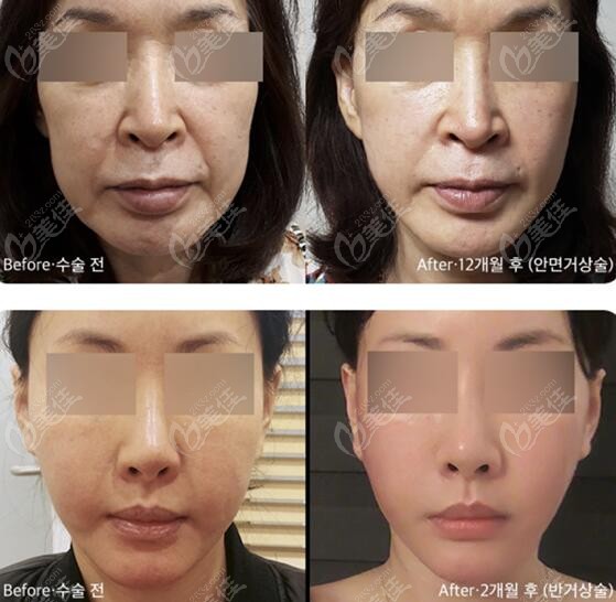 Comparison Photos of SMAS Face Lift and Wrinkle Reduction