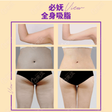 View Plastic Surgery's multidimensional liposuction for body shaping is impressive.