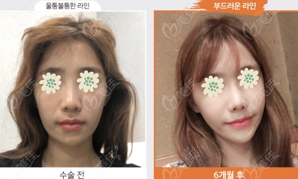 Comparison photos before and after the Korean three-piece contouring surgery▼