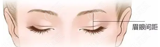  Double Eyelid Surgery