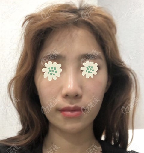 My real experience of undergoing the three-piece contouring surgery in Korea