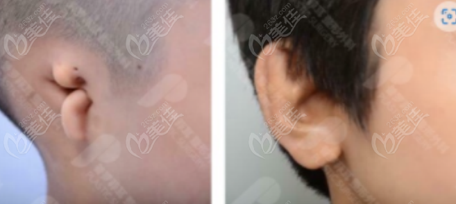 ear reconstruction surgery