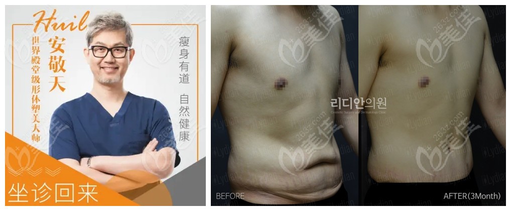  male abdominal muscle sculpting