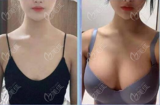 Breast Augmentation at Wonjin Plastic Surgery