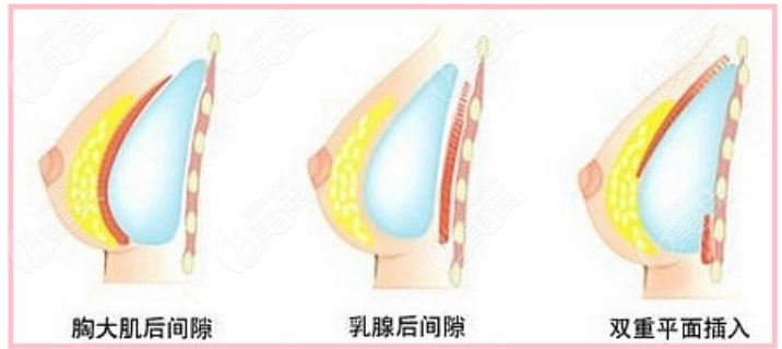 Breast Augmentation