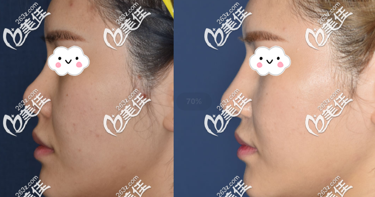 rhinoplasty repair