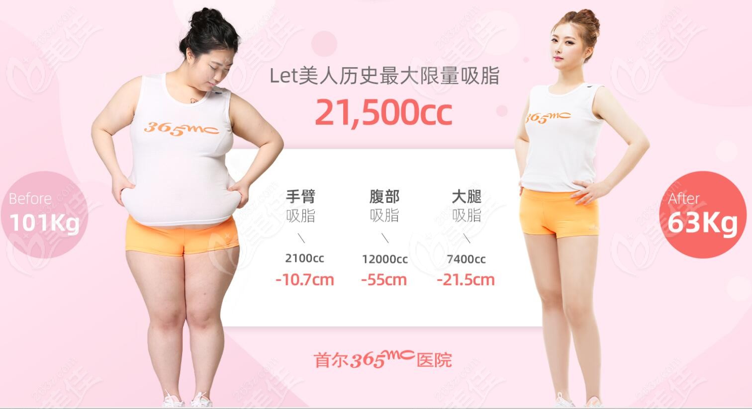 Image of a before and after liposuction performed by 365mc Hospital.